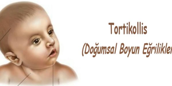Tortikollis  (Doğumsal Boyun Eğrilikleri)
