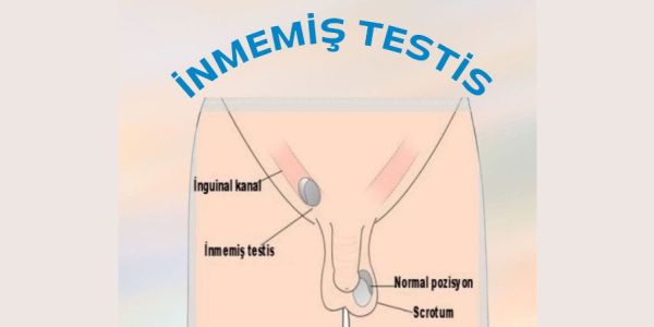 İnmemiş testisin zararları nelerdir ?