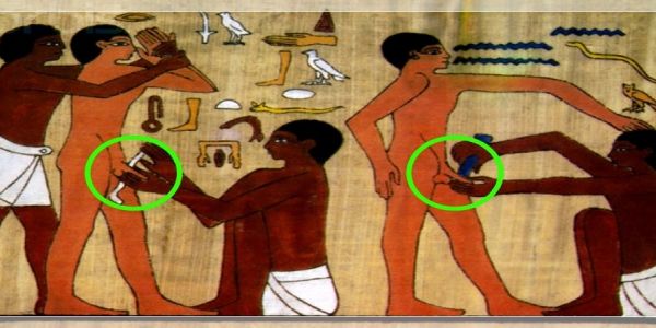 Hipospadias (Peygamber S&uuml;nnetli)